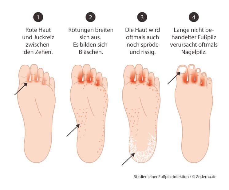 Fußpilz erkennen: Die verschiedenen Stadien von Fußpilz