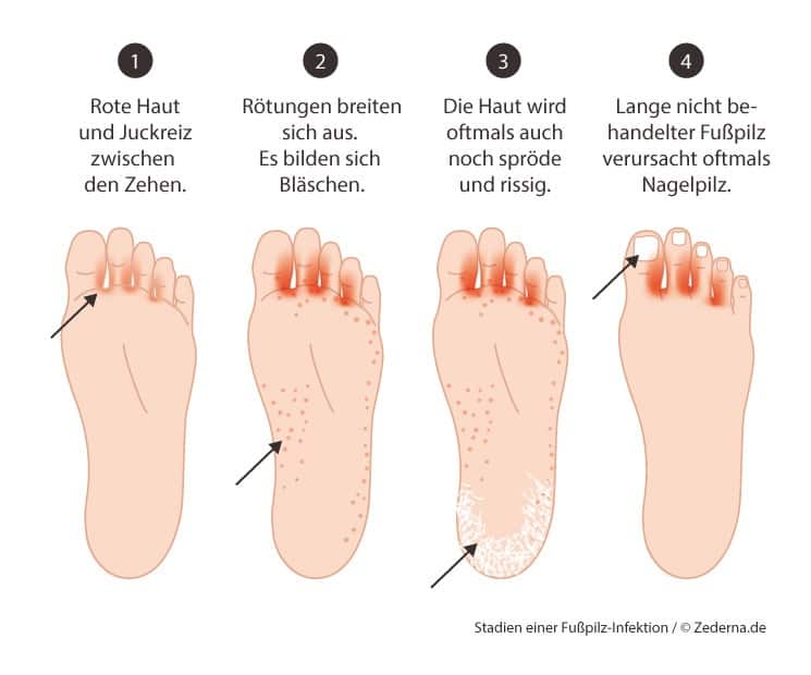 Gegen Fußpilz - die Stadien von Fußpilz erkennen